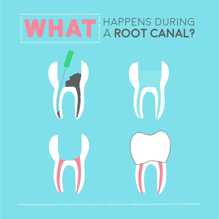 Does Dental Insurance Cover Root Canals