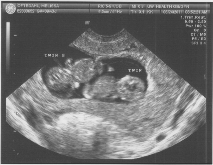 When will I have my first scan if I m in fertility treatment