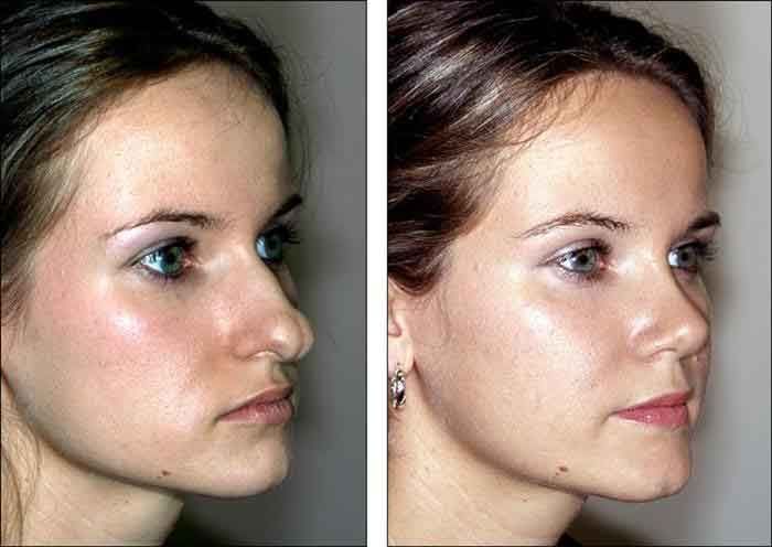 Fettabsaugung des Gesichts vor und nach dem Abnehmen Fettabsaugung des Gesichts vor und nach dem Abnehmen