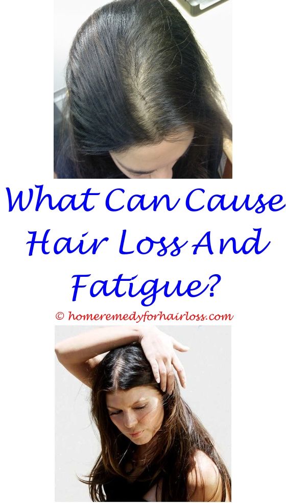 17 best Alopecia Hair Loss images on Pinterest | Hair fall remedy ...