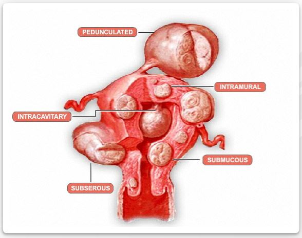 Natural Cure For Endometriosis And Fibroids Natural Cure For Endometriosis And Fibroids