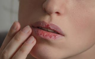 Cracked or chapped lips is a common condition affecting