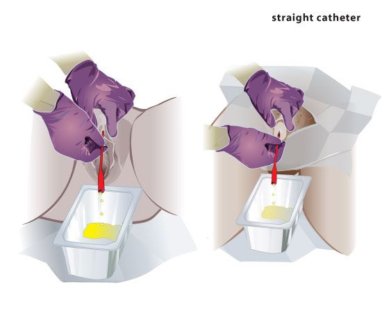 straight catheterization