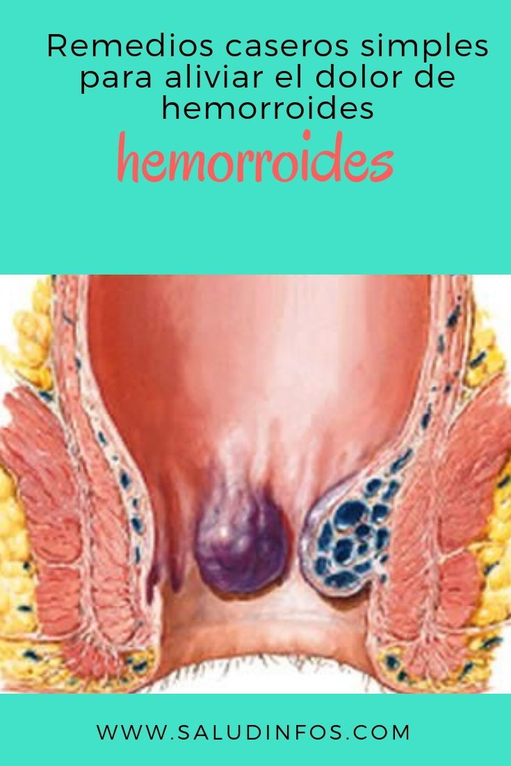 como aliviar el dolor de hemorroides rapido