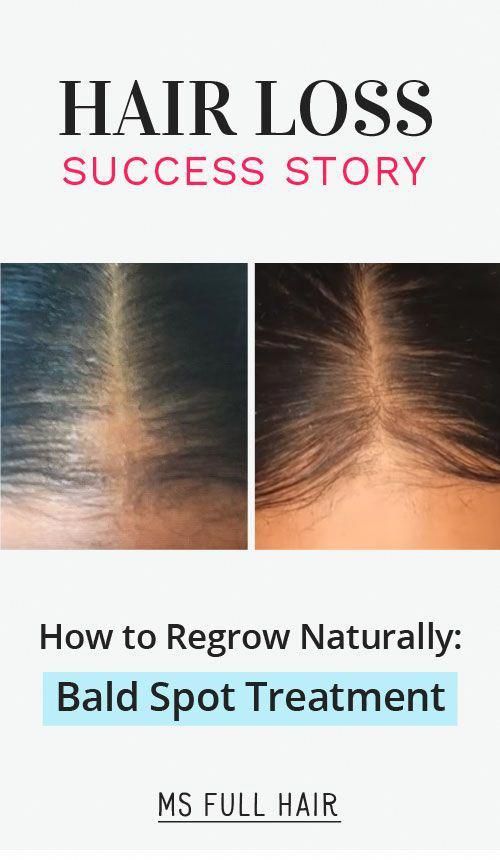 Success She Found The Best Bald Spot Treatment Formula Included