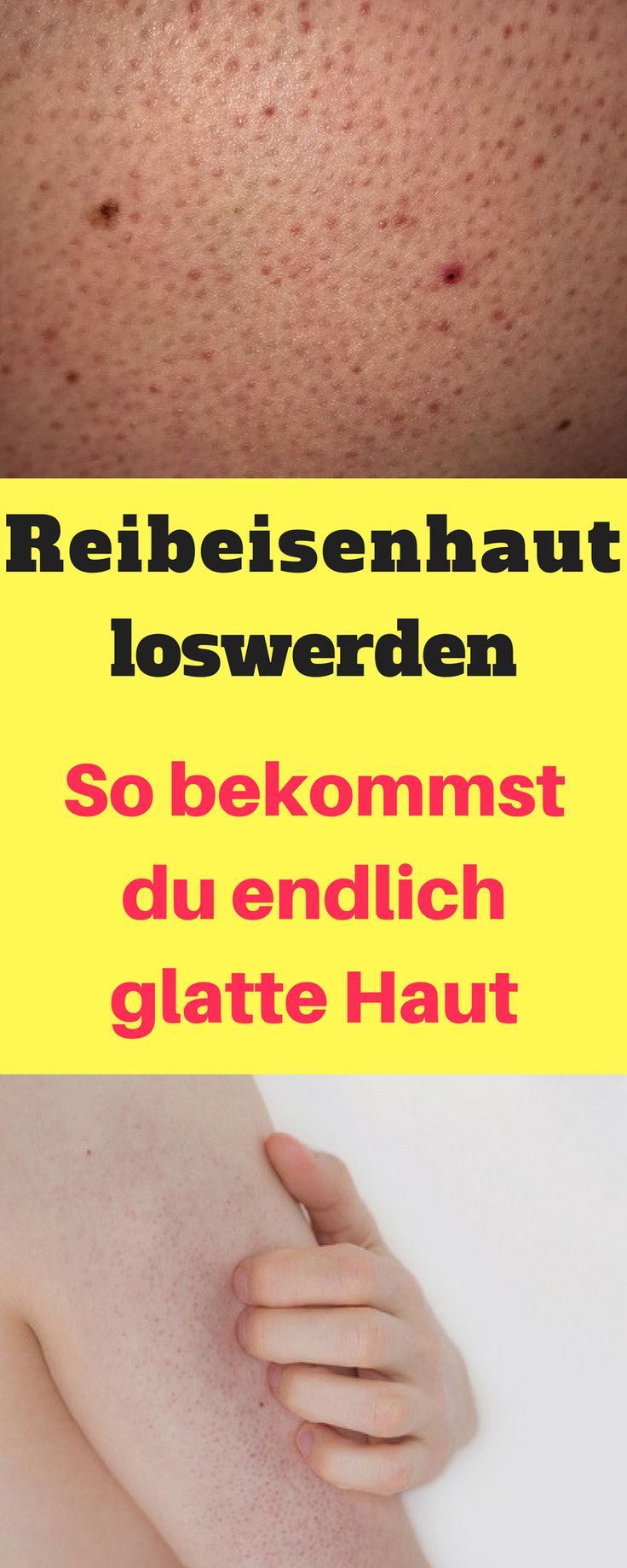 Diese natürlichen Mittel helfen gegen die Reibeisenhaut. Reibeisenhaut Hausmittel, Reibeisenhaut Beine, Reibeisenhaut Gesicht, Keratosis pilaris loswerden, Kokosöl für weiche haut, Peeling selber machen weiche Haut, Hausmittel weiche Haut, Meersalzpeeling für weiche und sanfte haut, trockene Haut Hausmittel, trockene Haut Tipps Peeling Home Remedies, Fitness, Natural Remedies, Wellness, Remedies, Prevent Hair Loss, Healthy Skin, Salud, Facial Warts