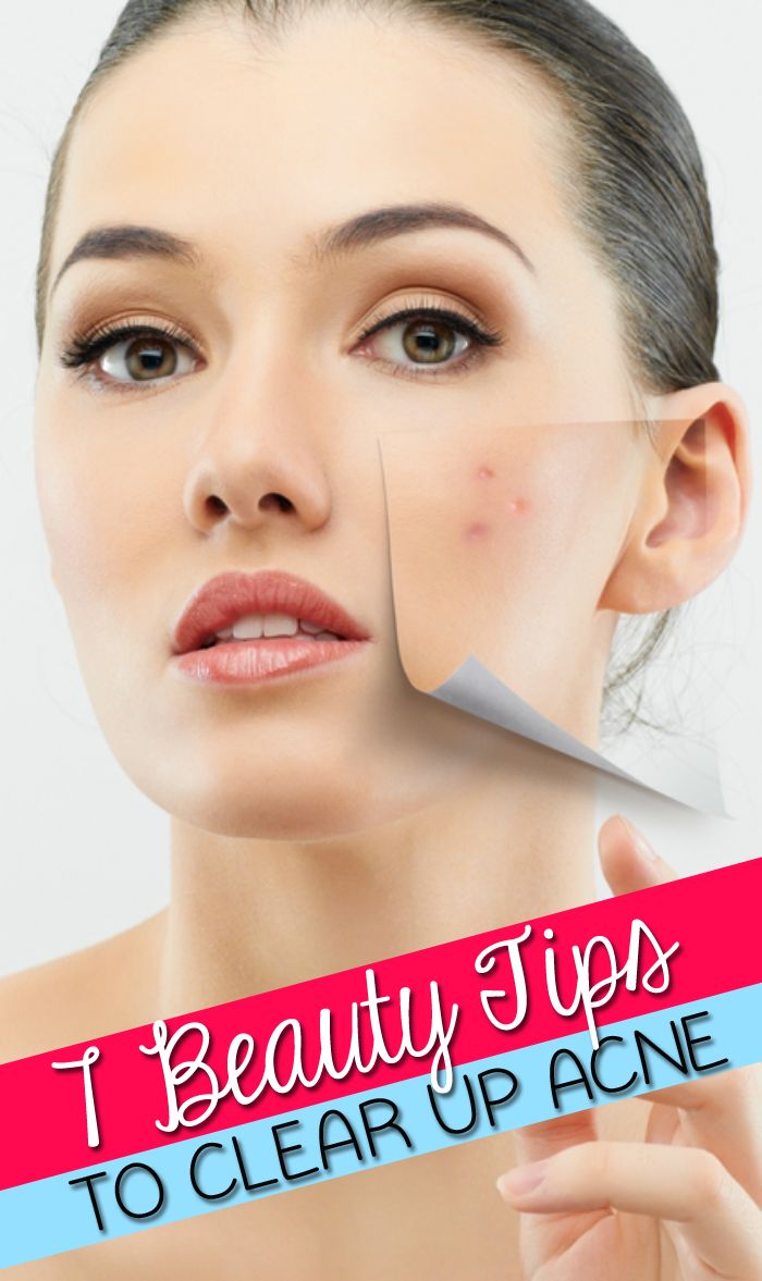 Clear Acne Overnight Using Natural Methods Clear Acne Overnight Using Natural Methods