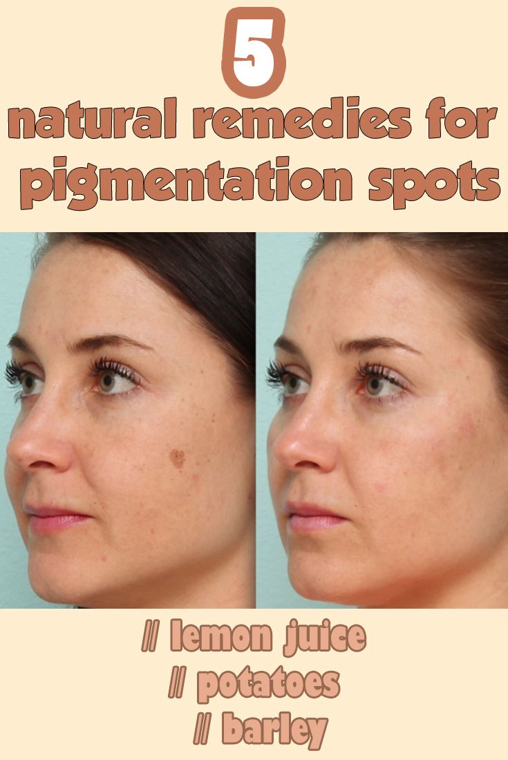 Home Remedies For Brown Spots On Face Home Remedies For Brown Spots On Face