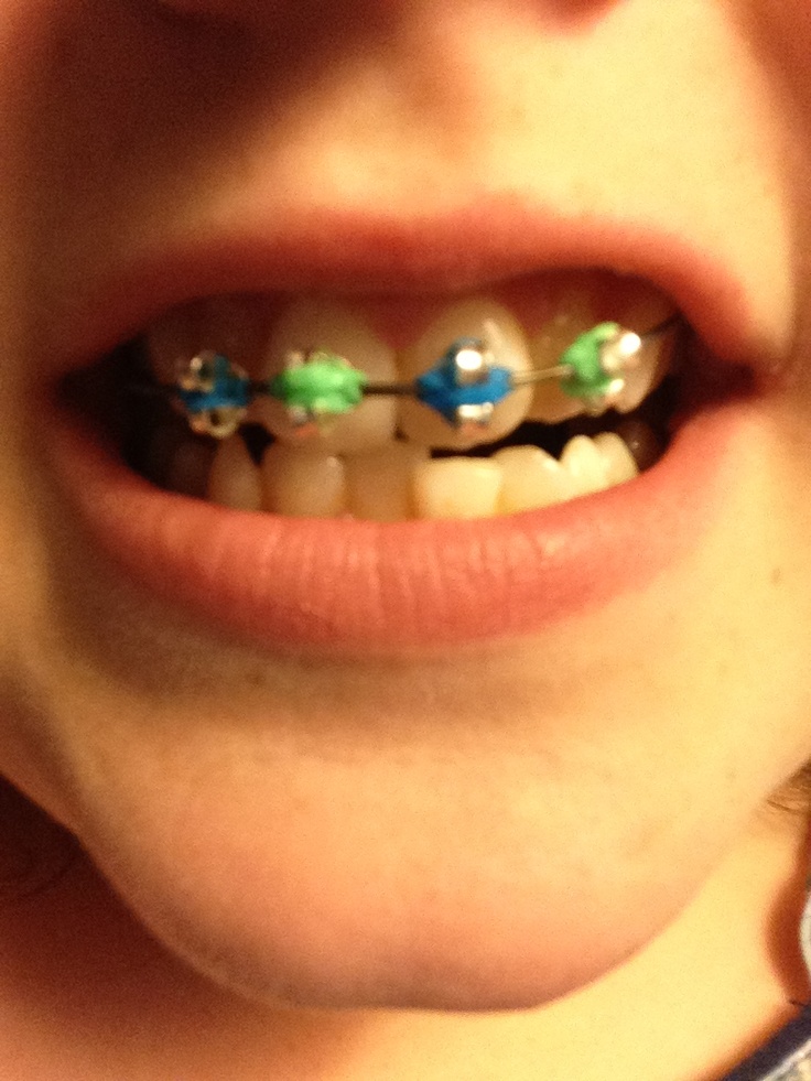 How To Make Fake Braces With Earring Backs