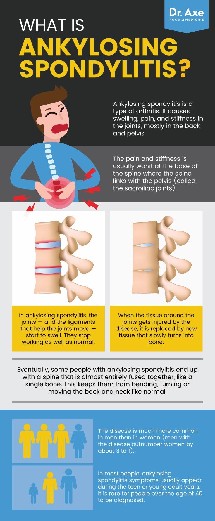 Ankylosing Spondylitis Infographic Ankylosing Spondylitis Ankylosing Spondylitis Exercise Psoriatic Arthritis