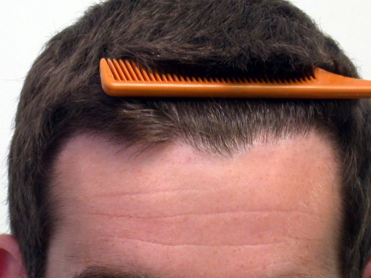 13 best Hair Transplant in Saudi Arabia images on Pinterest ...