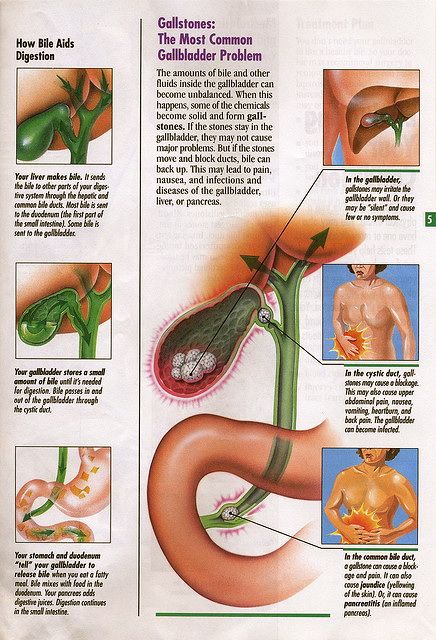 Natural Medicine For Gall Stones Natural Medicine For Gall Stones