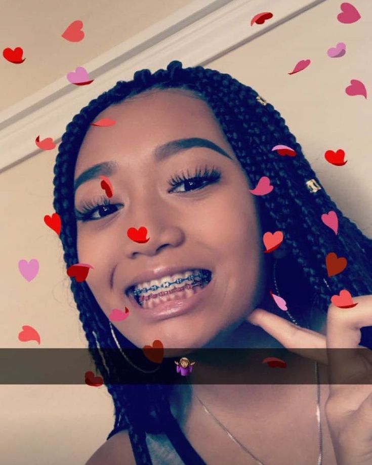 ⚠️credit Before Reposting Give It Sus ⚠️ Xoxo Shesoboujie Braces Colors Cute Braces