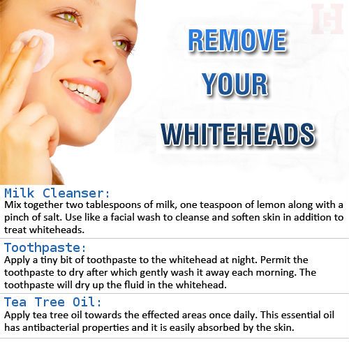 Does Toothpaste Get Rid Of Whiteheads Does Toothpaste Get Rid Of Whiteheads