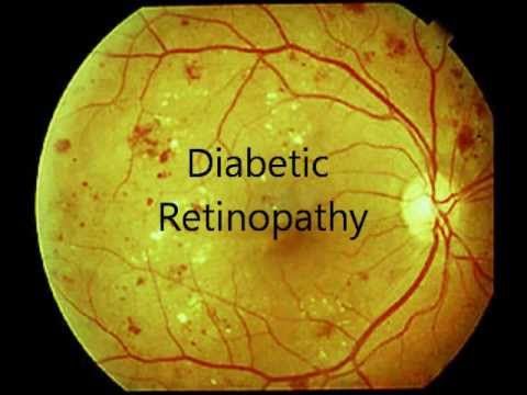 The outcome of diabetic retinopathy