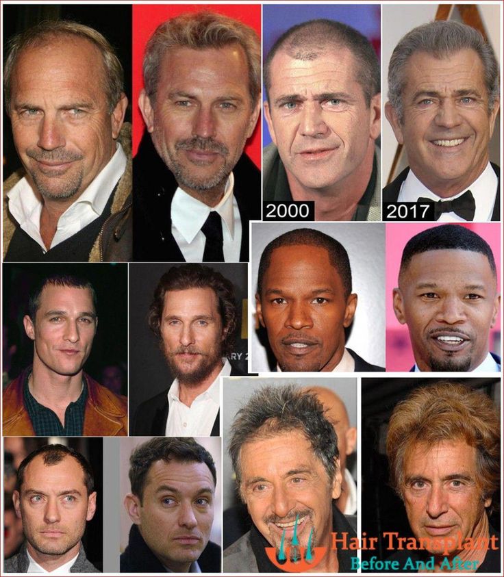 Celebrities Who Have Had Hair Transplants | Este Prime Clinic » Fue