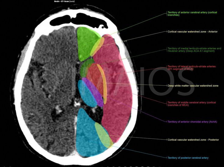 pica syndrome brain pica syndrome brain
