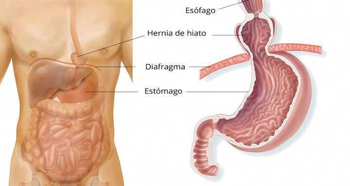 hernia de hiato se puede operar hernia de hiato se puede operar