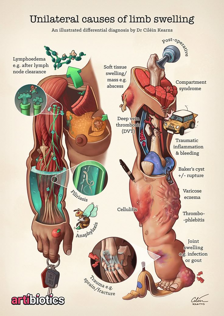 Figure #1: # # # #Causes #of #unilateral #limb #swelling: #lymphoedema, #post #operative #swelling, #trauma #(e.g. #sprain, #fracture, #inflammation, #and #bleeding), #compartment #syndrome, #soft #tissue #swelling/mass #(e.g. #abscess), #deep #vein #thrombosis #(DVT), #cellulitis, #Baker’s #cyst, #varicose #eczema, #thrombophlebitis, #joint #swelling #(e.g. #infection #of #gout), #anaphylaxis, #filiriasis. #Medical #illustration #by #Dr #Ciléin #Kearns #(Artibiotics). # # # #PDF #posters #here # # #.