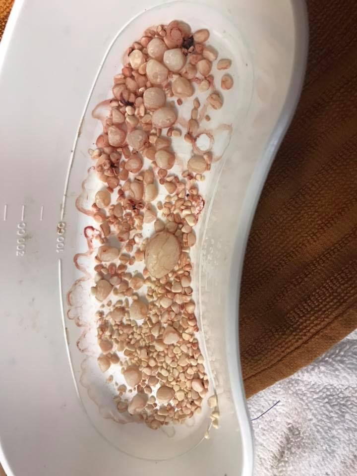From Kristina Sue Hubbard: "Bladder stones in a small dog. Died a few