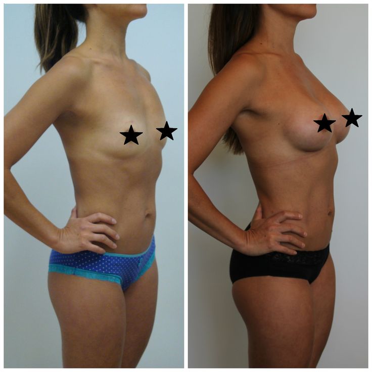 Consider, that breast augumentation b cup Breast augumentation b cup event