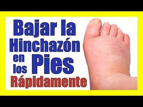hinchazon de pies en un diabetico