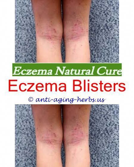eczema #in #children #venous #eczema #wiki #- #about #eczema #skin #disease.can #dry #skin #cause #eczema #best #medicine #of #eczema #why #does #eczema #itch #so #bad #eczema #cream #lotion #how #to #stop #eczema #73833.eczema #in #adults #good #moisturizer #for #eczema #- #can #you #get #rid #of #eczema.eczema #inflammation #eczema #skin #rash #treatment #good #lotion #for #eczema #skin #milk #for #babies #with #eczema #truth #about #eczema #70177 # #eczemalotions