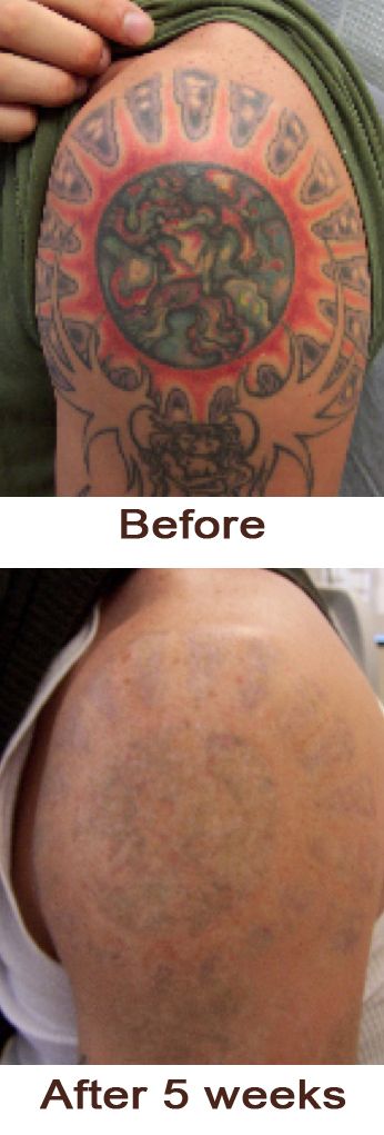 60 best laserless tattoo removal effective natural tattoo 60 best laserless tattoo removal effective natural tattoo