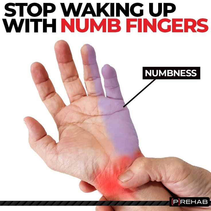 Numbness In Fingers Physical Therapy Student Ulnar Nerve Finger numbness-in-fingers-physical-therapy-student-ulnar-nerve-finger