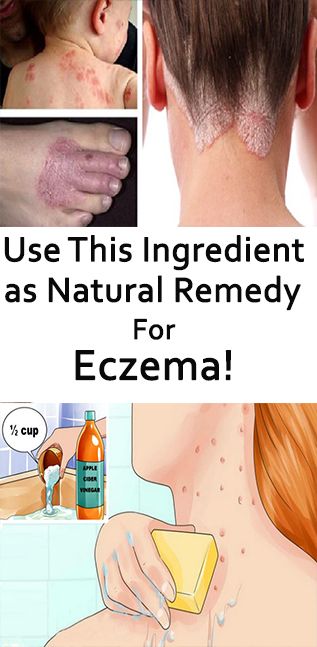 Treating Eczema Naturally Diet Treating Eczema Naturally Diet
