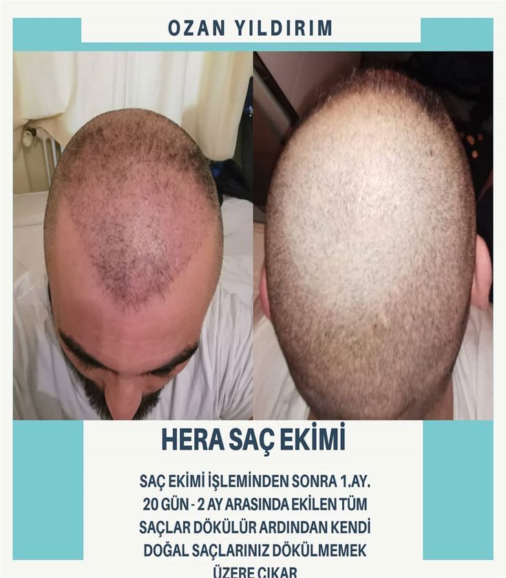 Islemden Sonra 2 Seans Prp Hed Dogal Sac Sac Dokulmesi Meze Islemden Sonra 2 Seans Prp Hed Dogal Sac Sac Dokulmesi Meze