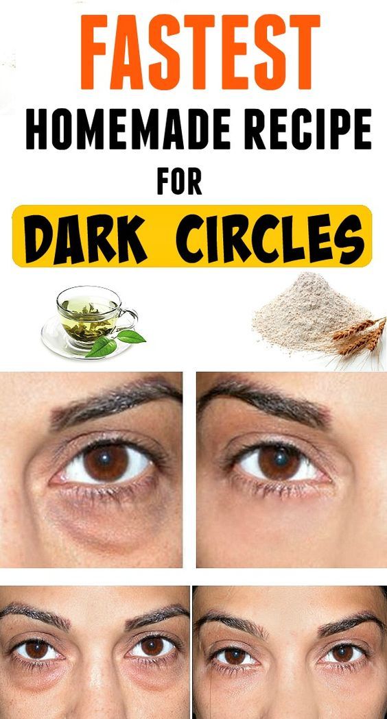 remove black circles under eyes home remedy