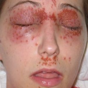 Cure for facial warts Shower glass door floppy cock bulge