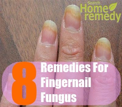 Fingernail Infection Natural Remedy Fingernail Infection Natural Remedy