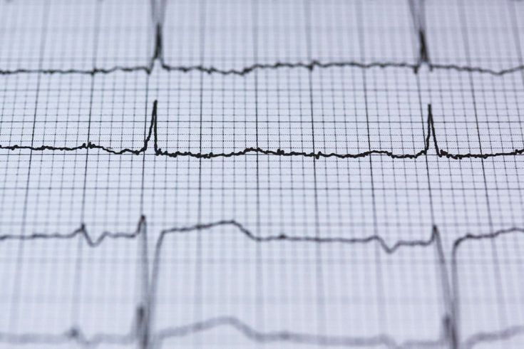 #blur #chart #check up #curve #data #diagram #ecg #electrocardiogram #frequency #graph #grid #health #health check #healthcare #heart #heartbeat #horizontal #medical #paper #pulse #recording #result #rhythm #science