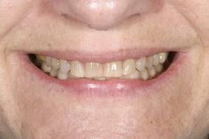 best 7 carillas dentales ideas on pinterest carillas dentales