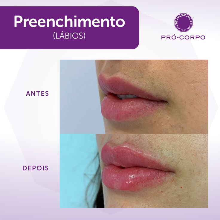 1 Ml De Preenchimento Labial Antes E Depois Preenchimento Labial | Lábios perfeitos, Labial, Preenchimento