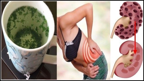 Elimina Las Piedras De Riñón Sin Dolor Con Este Remedio Casero Increíble Las Estadísticas Muestran Q Kidney Detox Cleanse Healthy Detox Cleanse Kidney Cleanse