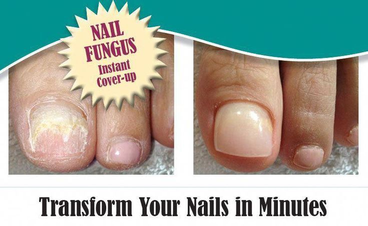 Spas And Nail Salons Understand That Every Foot Isnt Perfect Many Offer Specia Nail Fungus Treatment Nail Fungus Remedy Nail Fungus