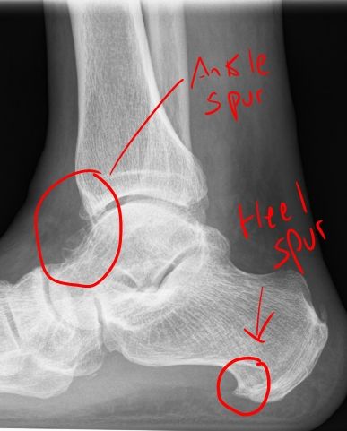 Natural Remedy For Bone Spurs In Neck Natural Remedy For Bone Spurs In Neck