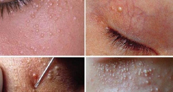 Have You Ever Heard Of The Term Milia Well If You Haven T Then You Should Definitely Read The Article Below First Let Me Tell You W Whiter Skin Cysts Skin Have You Ever Heard Of The Term Milia Well If You Haven T Then You Should Definitely Read The Article Below First Let Me Tell You W Whiter Skin Cysts Skin