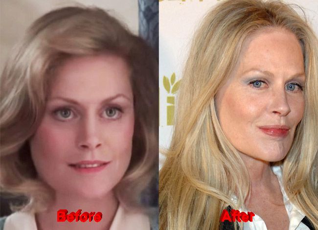 beverly-dangelo-plastic-surgery-before-after | Plastic surgery, Beverly