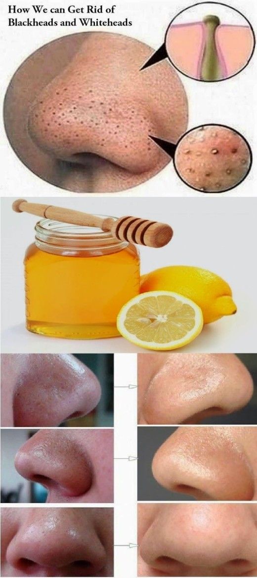 How To Remove Hair From Nose Tip Naturally How To Remove Hair From Nose Tip Naturally