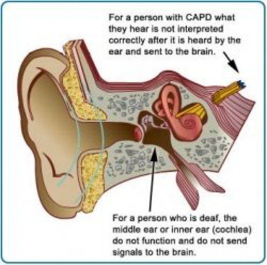 auditory processing disorder in adults wiki auditory processing disorder in adults wiki