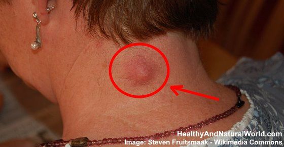 How To Get Rid Of Boils Naturally And Quickly How To Get Rid Of Boils Naturally And Quickly