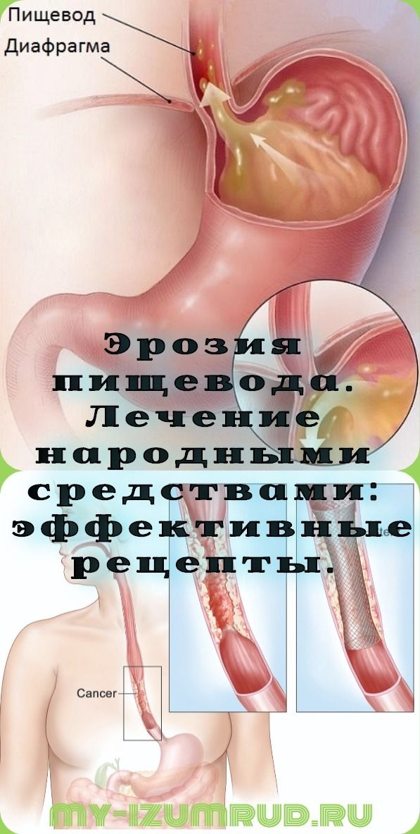 пищевод диета пищевод диета
