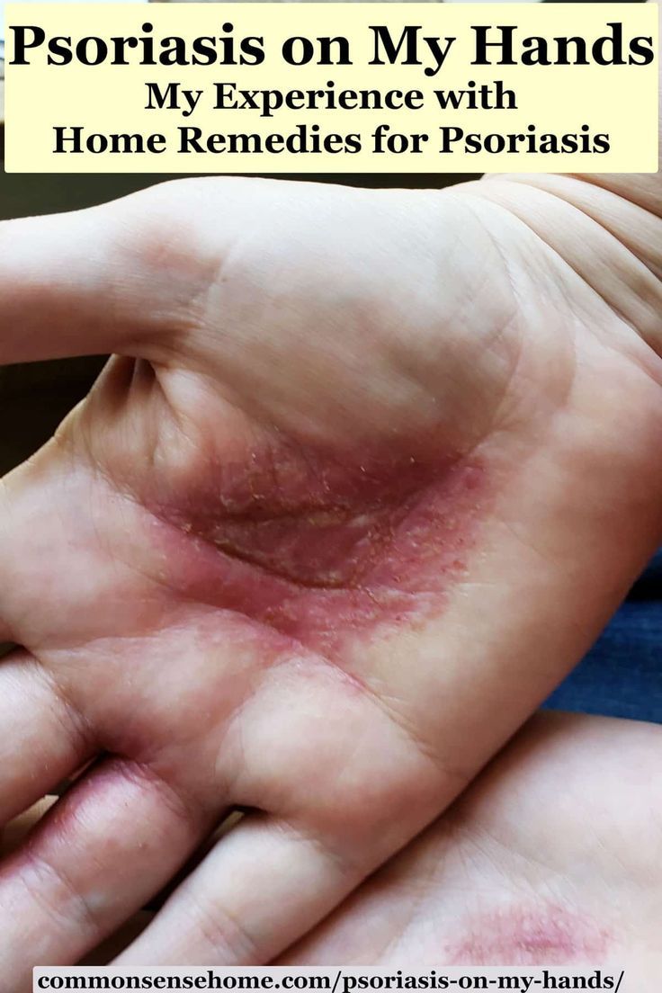 psoriasis on feet home remedy