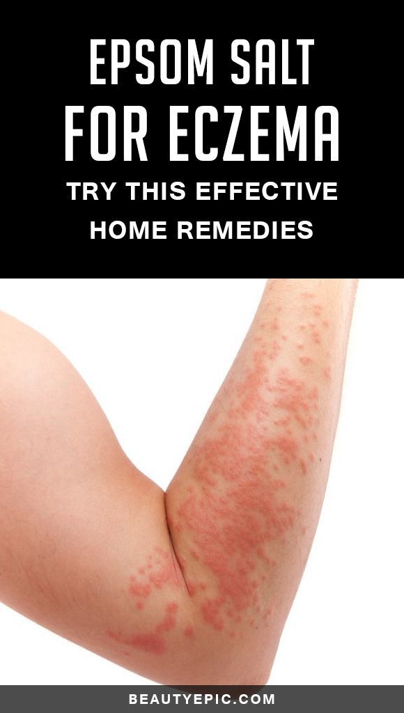Natural Treatments For Rosacea Uk Natural Treatments For Rosacea Uk
