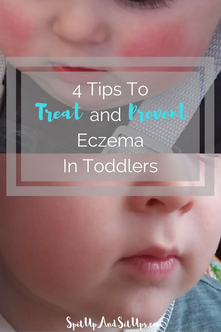 Natural Ways To Treat Eczema In Toddlers Natural Ways To Treat Eczema In Toddlers