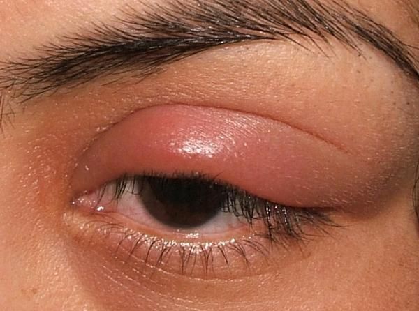 Stye Is An Eye Inflammation In Which The Lower Of Upper Eyelid Swells Due To The Bacterial Infection Swollen Eyelids Remedy Swollen Eyelid Swollen Eye Remedies Stye Is An Eye Inflammation In Which The Lower Of Upper Eyelid Swells Due To The Bacterial Infection Swollen Eyelids Remedy Swollen Eyelid Swollen Eye Remedies